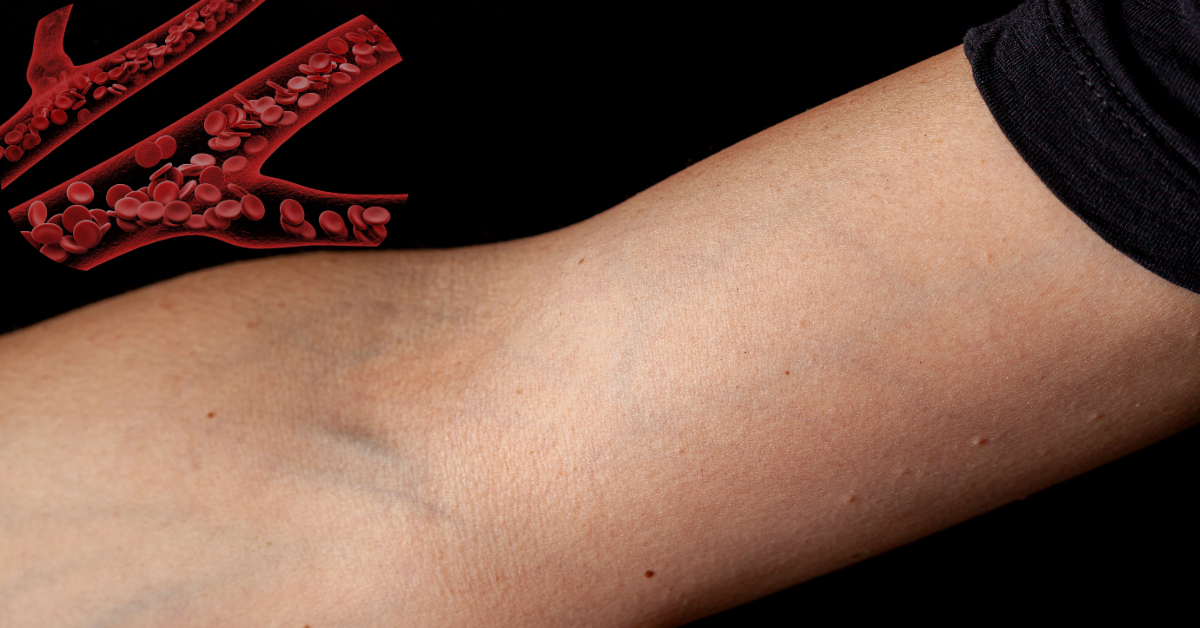 Cephalic Vein: Key Insights
