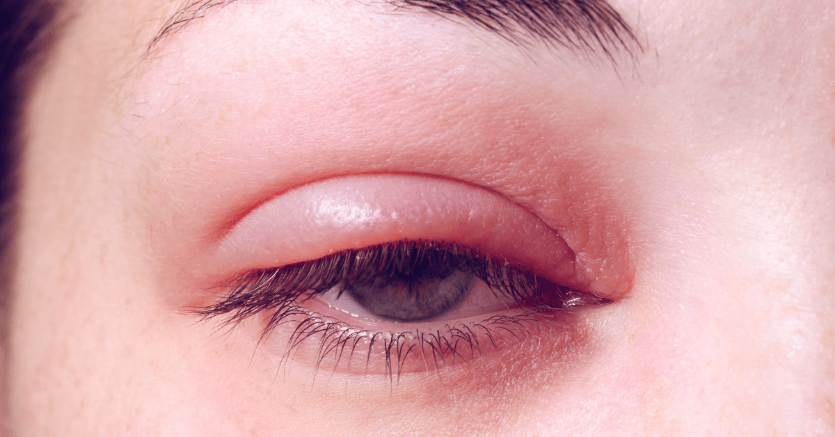 Antifungal Eye Drops List in 2025
